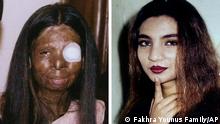 Pakistani acid victim Fakhra Younus committed suicide in March 2012 after a decade of surgery