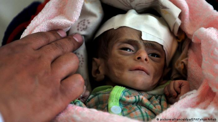 Unterernährtes drei Monate altes Baby (Foto: picture-alliance/dpa/EPA/Yahya Arhab)
