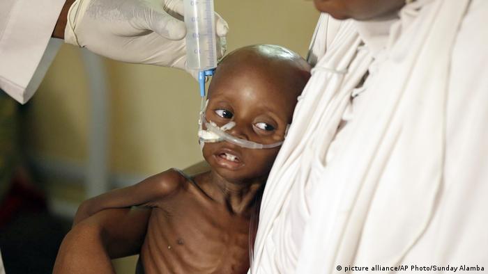 A malnourished African child being fed in hospital