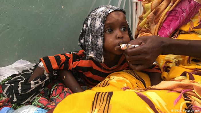 От август 2017 малката Ксамди е на лечение в клиниката Банадир в Могадишу, където има спешно отделение за недохранени деца. Ксамди е на три години и тежи само седем килограма. В тази възраст едно нормално развито дете тежи поне два пъти повече. На снимката се вижда как майката на Ксамди ѝ дава фъстъчена паста, която се използва често в лечението на недохранени деца. 