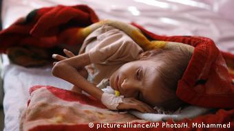 Criança iemenita subnutrida deitada em cama