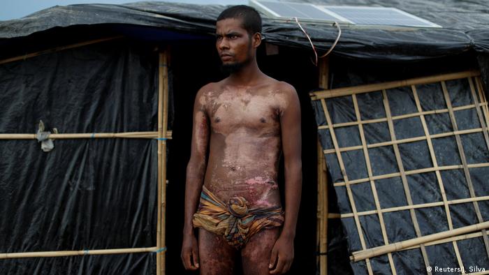 Myanmar Fotoreportage Rohingya Flüchtlinge Verletzungen (Reuters/J. Silva)