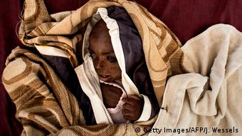 Demokratische Republik Kongo Unterernährtes Kind (Getty Images/AFP/J. Wessels)