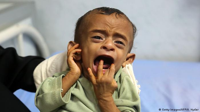 Jemen Hodeidah Unterernährte Kinder (Getty Images/AFP/A. Hyder)