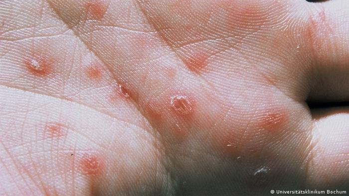 An up close picture of a hand with red blisters