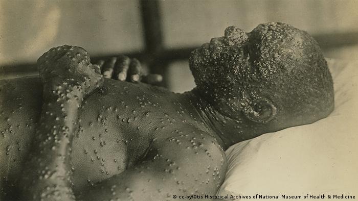 A smallpox patient (cc-by/Otis Historical Archives of National Museum of Health & Medicine)