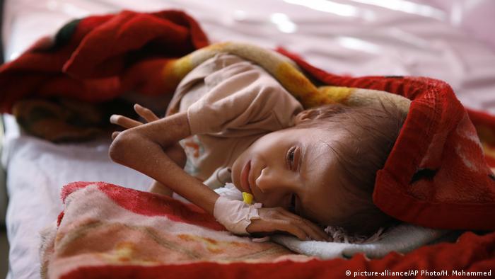 A malnourished child lies in a bed waiting to receive treatment at a therapeutic feeding center