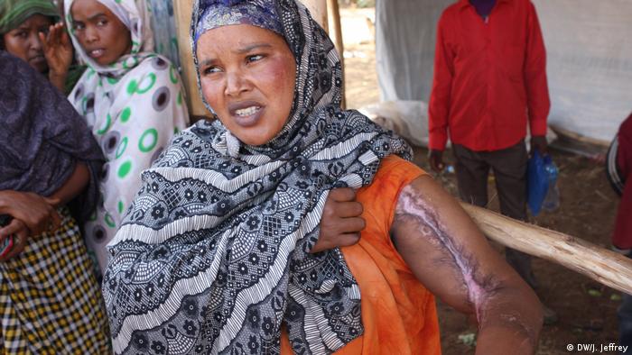 A displaced Somali woman exhibiting a scar on her arm
