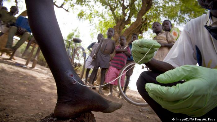 A patient being treated for guinea-worm disease (Imago/ZUMA Press/W. Pope)