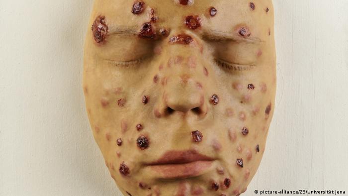 A wax model face showing the syphilis infection