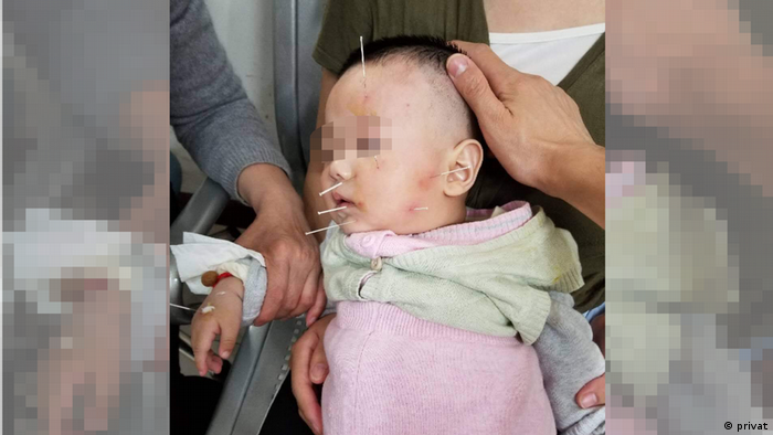 China Impfung Baby Gesichtslähmung (privat)