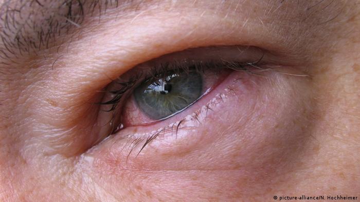 شعيرة العين التهاب مؤلم يمكن التخلص منه بوصفات منزلية عالم