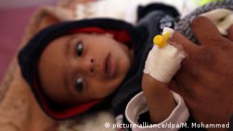 Παιδάκι με ελονοσία στην Υεμένη