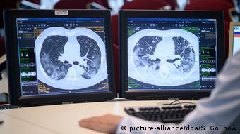 Οι ειδικοί θεωρούν ότι οι ασθενείς με σοβαρά συμπτώματα θα έχουν προβλήματα στην αναπνοή για μεγάλο χρονικό διάστημα